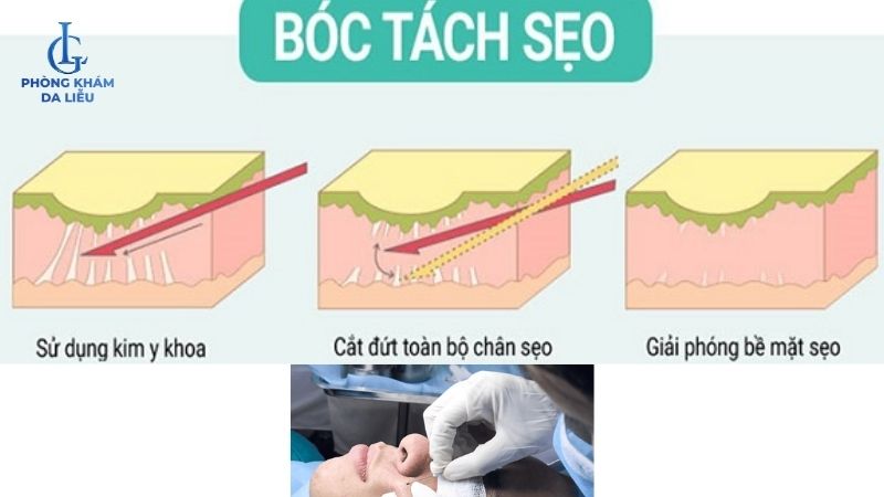 bóc tách đáy sẹo trị sẹo rỗ nặng