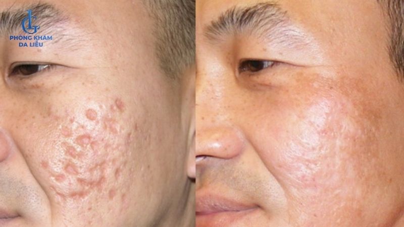 điều trị sẹo rỗ