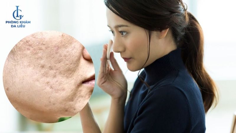 ảnh hưởng khi bị sẹo rỗ