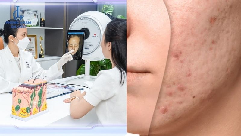 điều trị sẹo rỗ