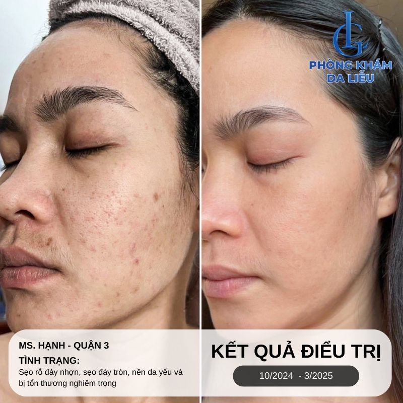 Kết quả trị sẹo rỗ