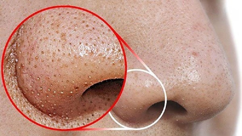 Mụn cám ở mũi