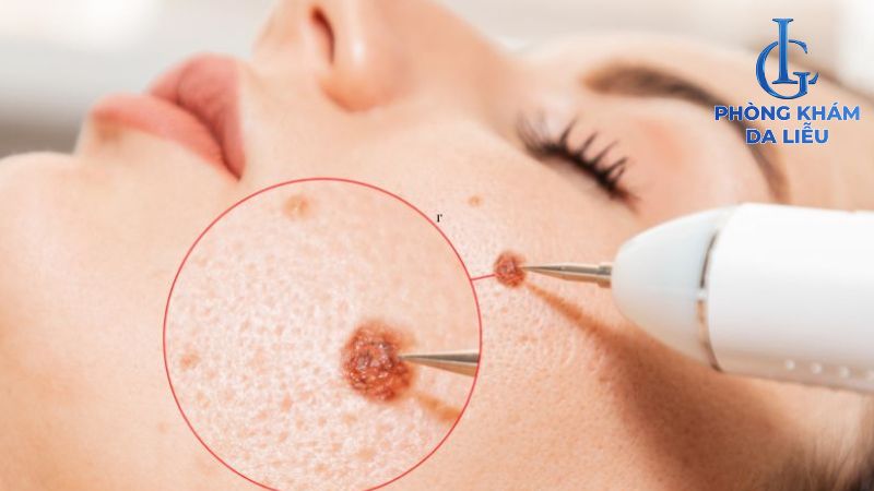 Tẩy nốt ruồi