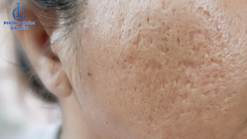 Sẹo rỗ có nhiều mức độ khác nhau