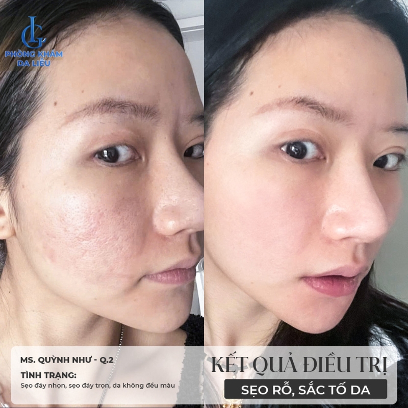 trị sẹo rỗ tại Phòng khám LG
