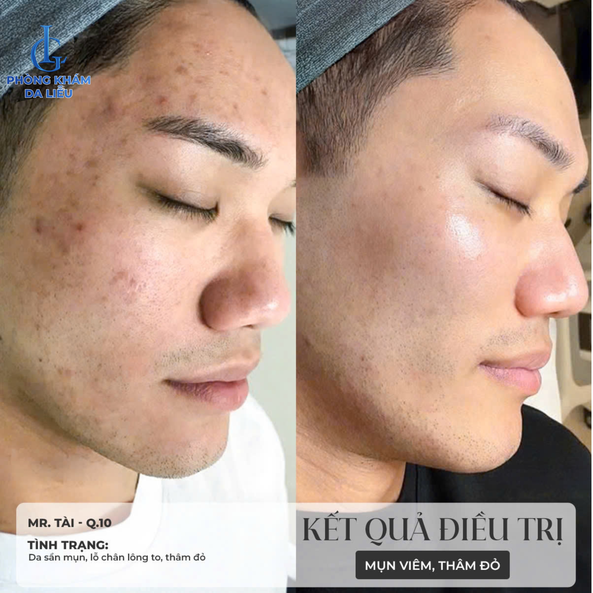 kết quả điều trị sẹo 