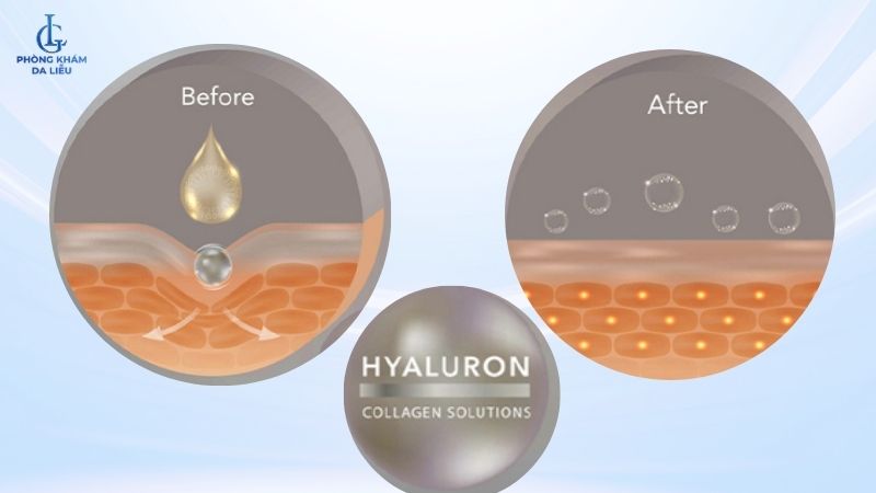 cơ chế tiêm làm đầy sẹo lõm