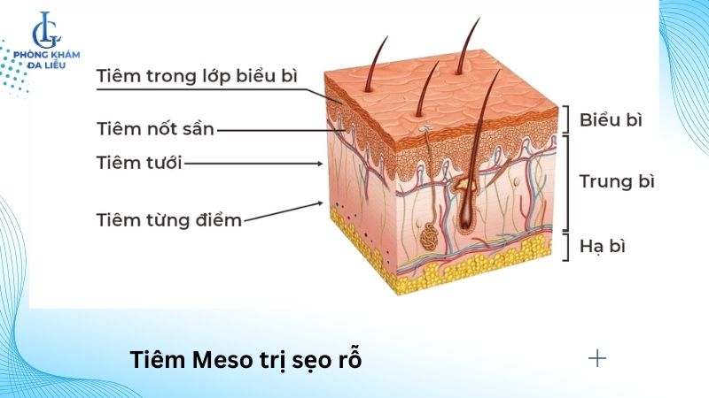 trị sẹo rỗ bằng phương pháp meso
