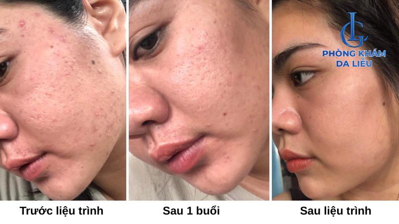 Quá trình hồi phục sẹo rỗ