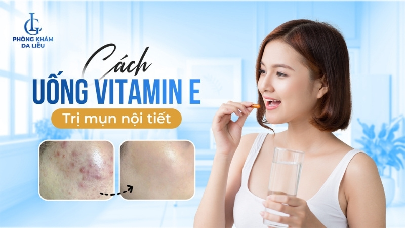 Uống vitamin E trị mụn nội tiết được không