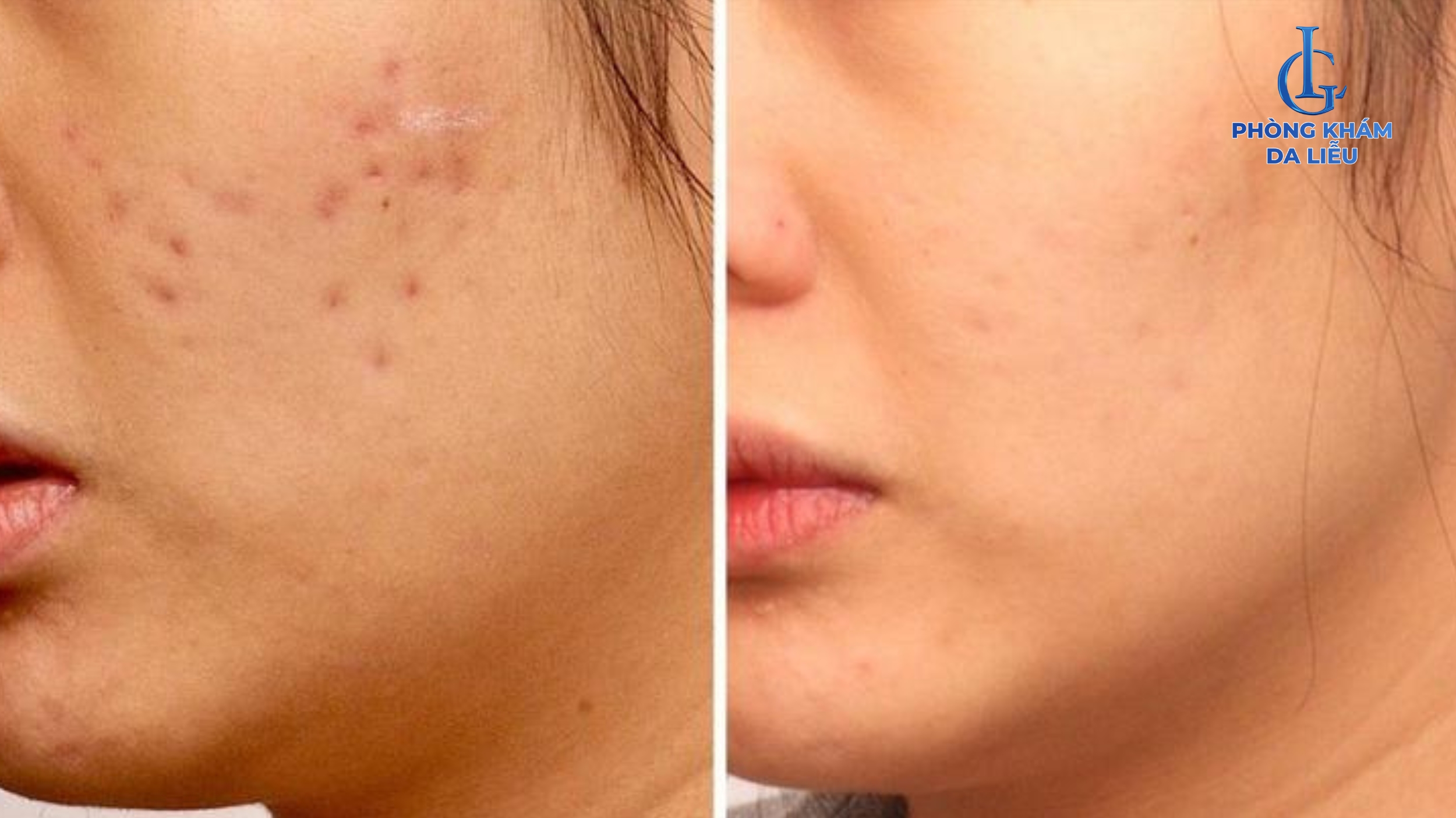 Sẹo nhẹ cải thiện nhanh