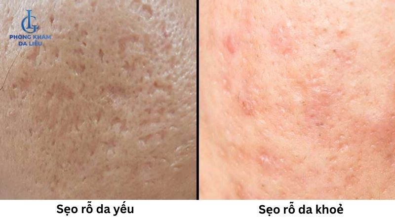 ảnh hưởng trị sẹo rỗ