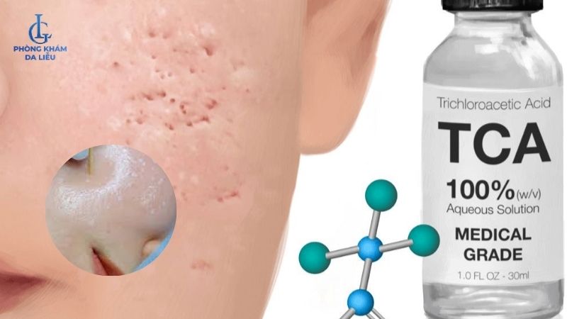 các loại peel da trị sẹo rỗ