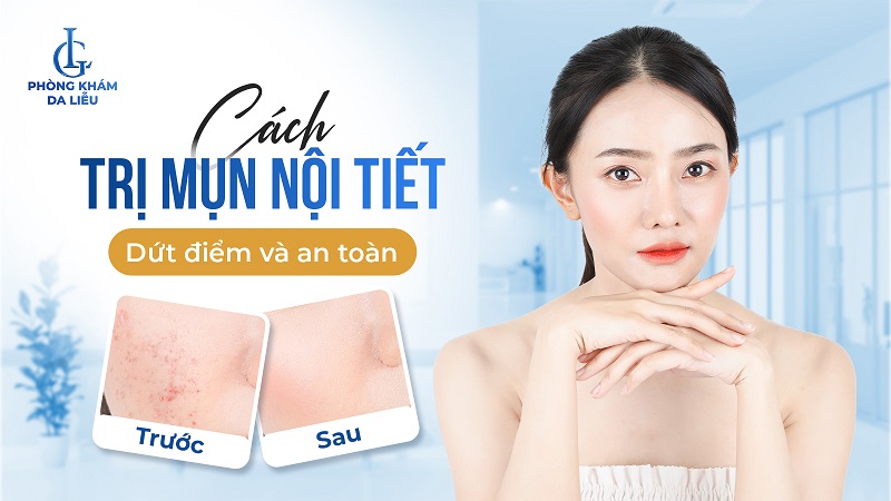 cách trị mụn nội tiết dứt điểm