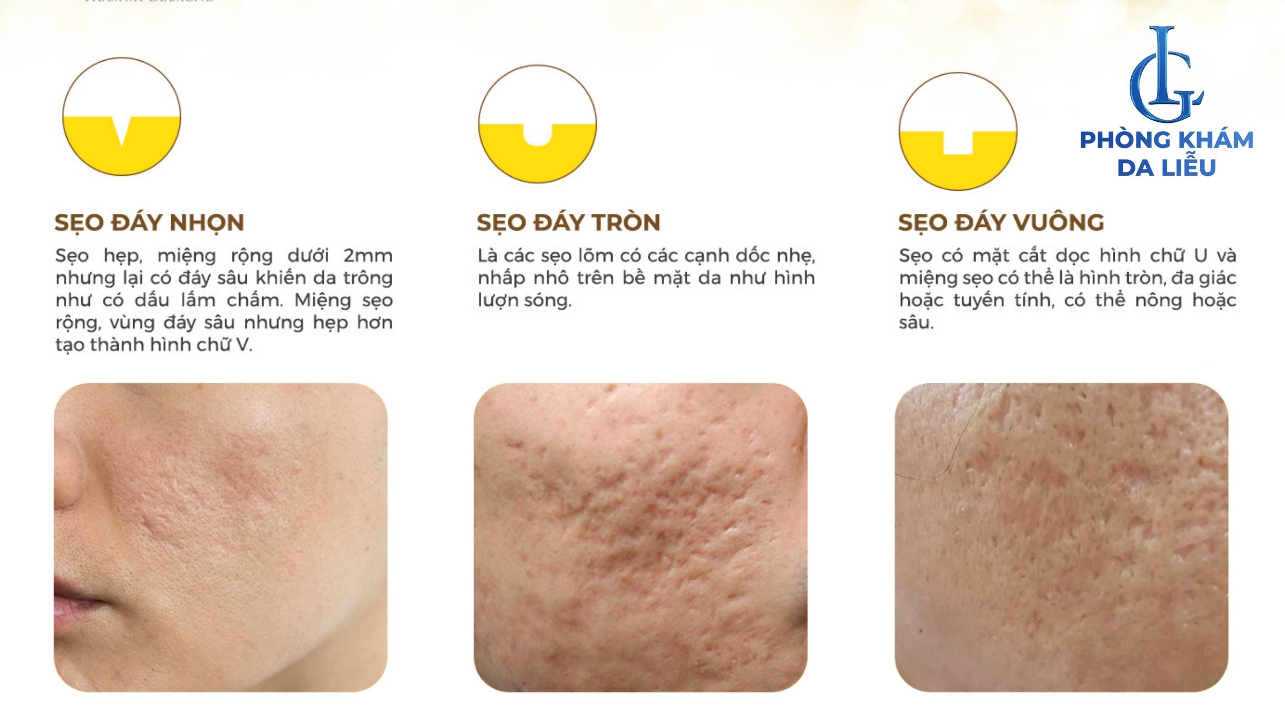 Các loại sẹo rỗ