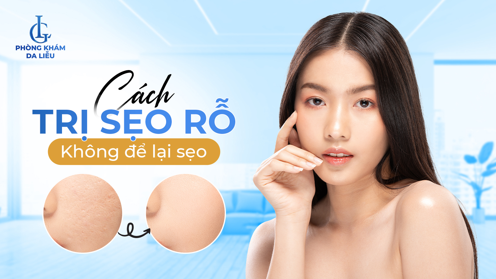 Cách trị sẹo rỗ