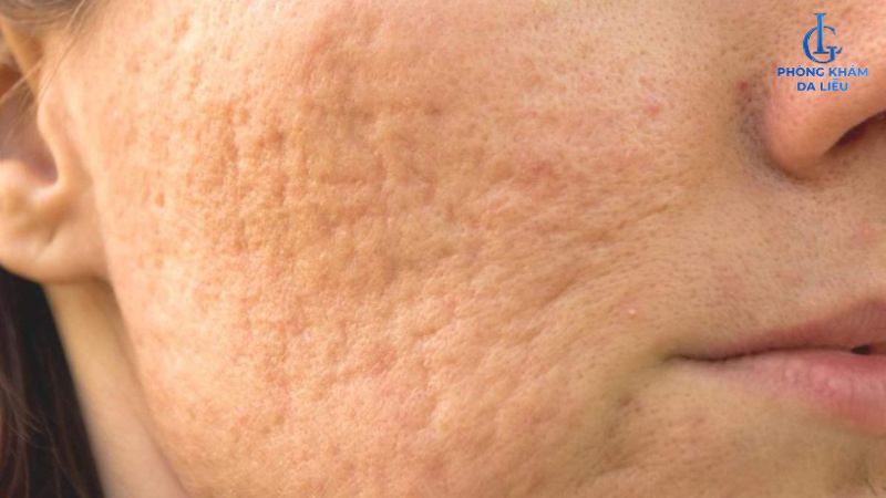 sẹo rỗ lâu năm có trị được không