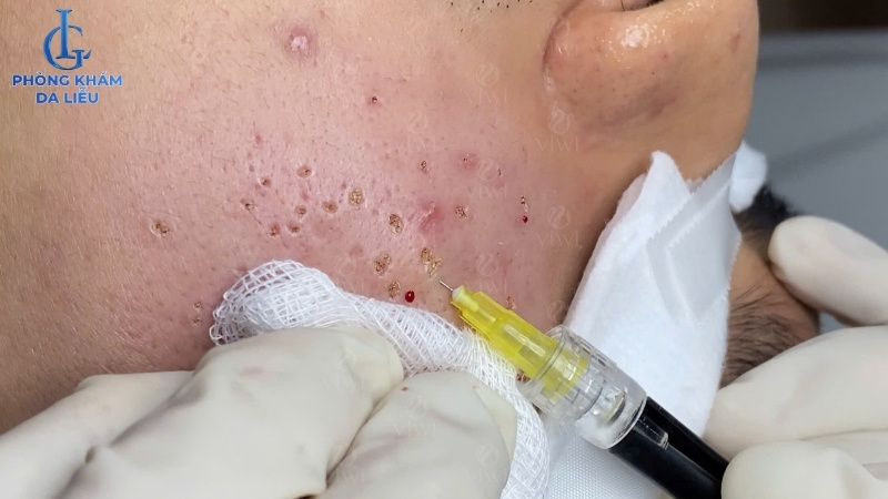 cắt đáy trị sẹo rỗ