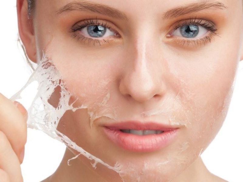 Có nên peel da sau khi nặn mụn không?