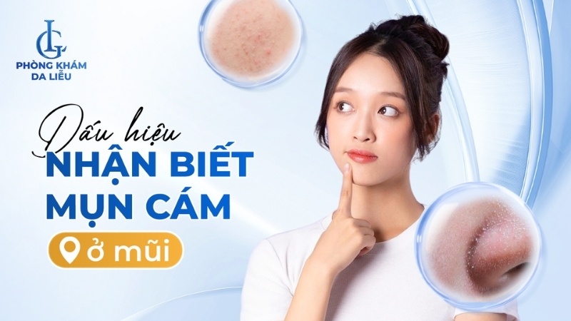 dấu hiệu nhận biết mụn cám ở trán