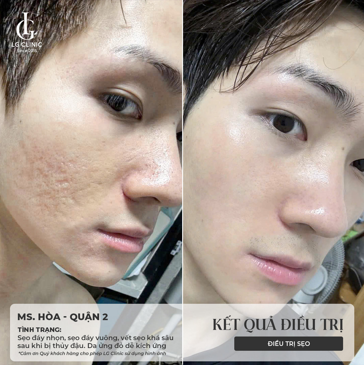 tiêm đầy sẹo rỗ