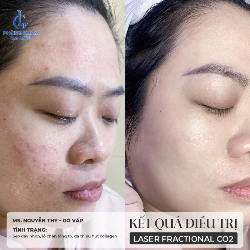 điều trị sẹo rỗ hiệu quả