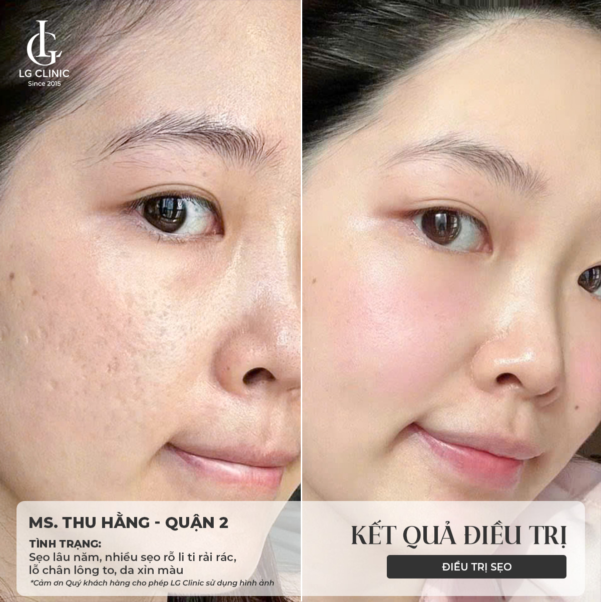 tiêm trị sẹo rỗ
