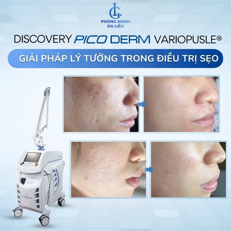 discovery-pico-derm-variopulse-dieu-tri-seo-ro