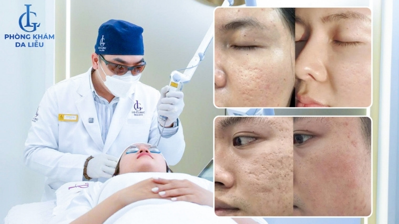 giá điều trị sẹo rỗ bằng công nghệ cao sẽ tốn kém hơn