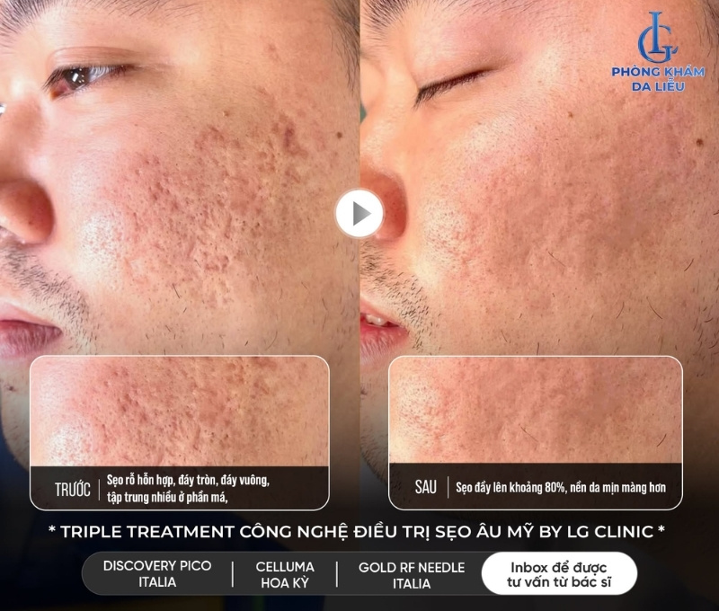 Hình ảnh trước và sau khi điều trị sẹo rỗ của khách hàng