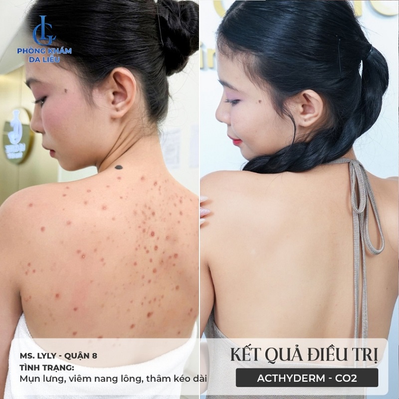 hình trước và sau khi trị mụn