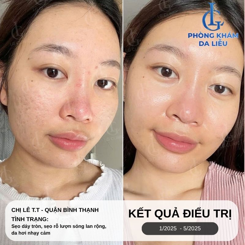 kết quả trị sẹo rỗ