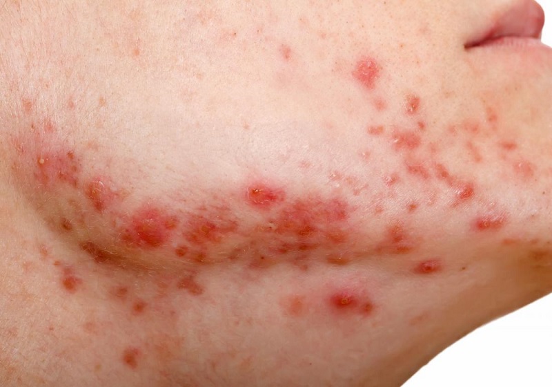 Làm sao biết mình bị mụn nội tiết