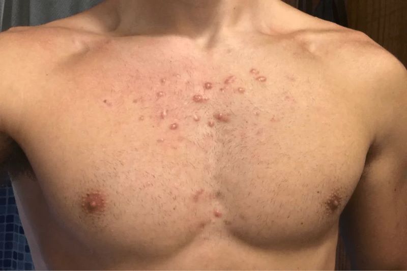 Mụn nội tiết ở ngực nam