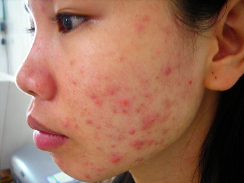 Mụn nội tiết ở má