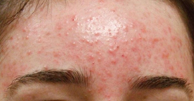 Mụn nội tiết ở trán