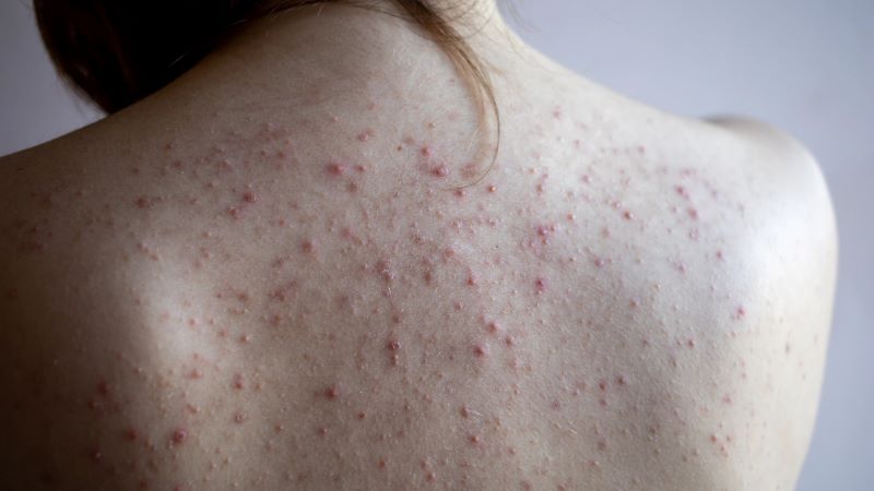 Mụn nội tiết ở lưng