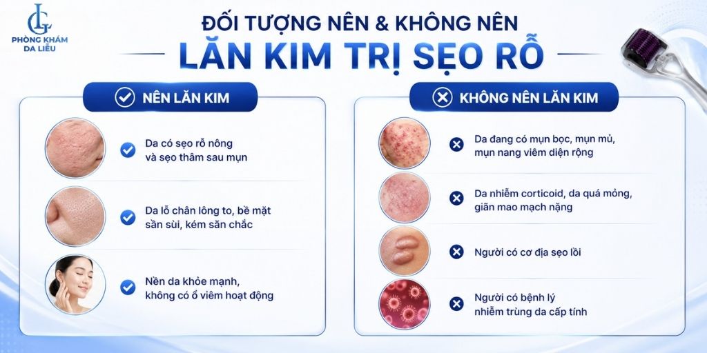Khi nào nên lăn kim trị sẹo rỗ