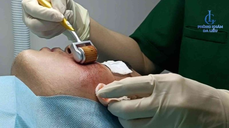 lăn kim trị sẹo rỗ