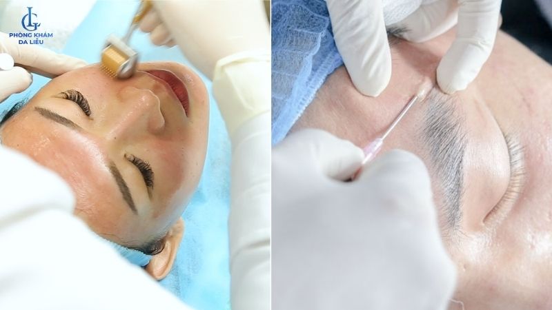 Lăn kim và tách đáy sẹo