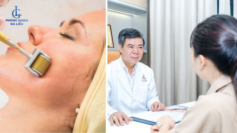 lăn kim có trị được sẹo rỗ không