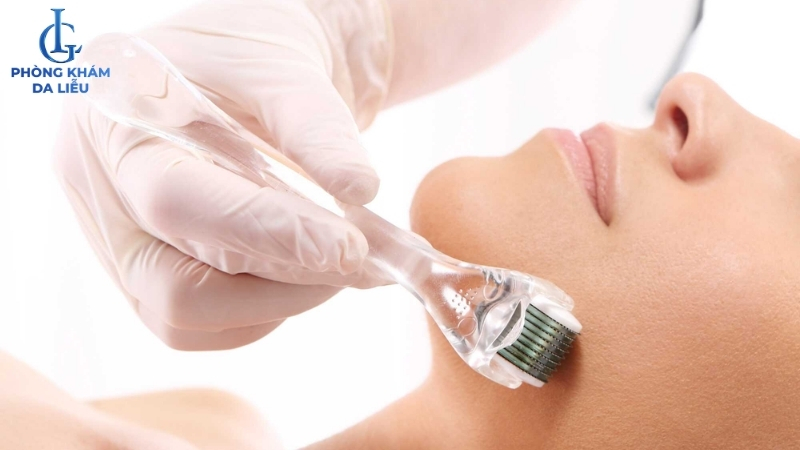 lăn kim trị sẹo rỗ