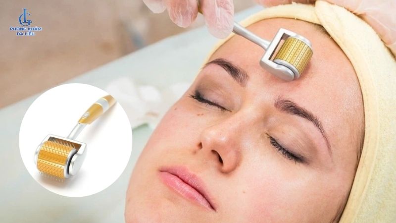 Lăm kim trị sẹo rỗ