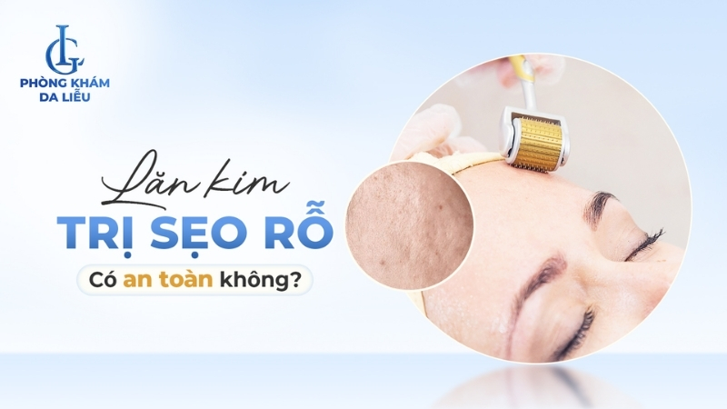 lăn kim trị sẹo rỗ có hiệu quả không