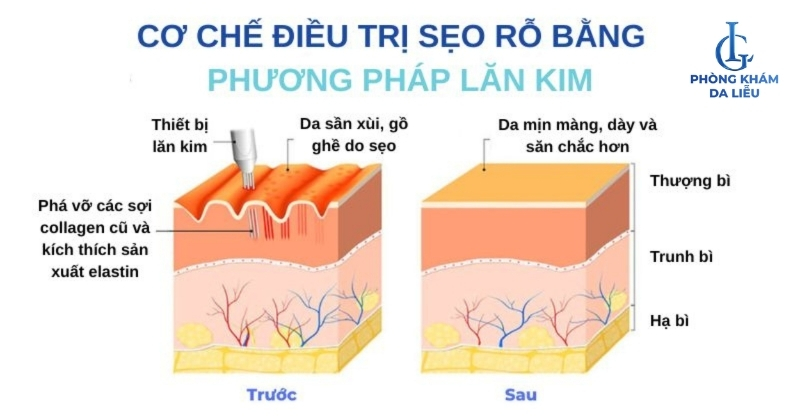 lăn kim trị sẹo rỗ là gì