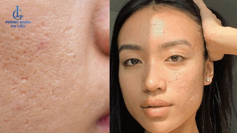 liệu trinh điều trị sẹo rỗ