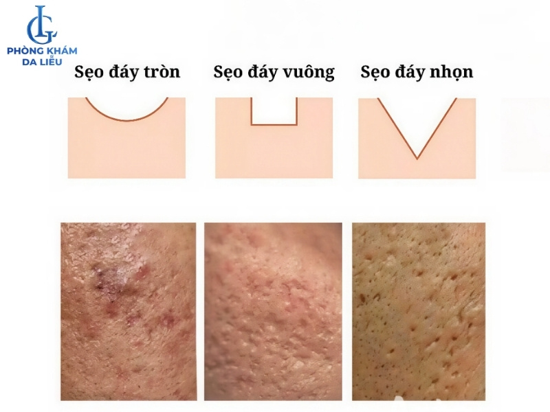 liệu trình trị sẹo rỗ bao lâu dựa vào loại sẹo
