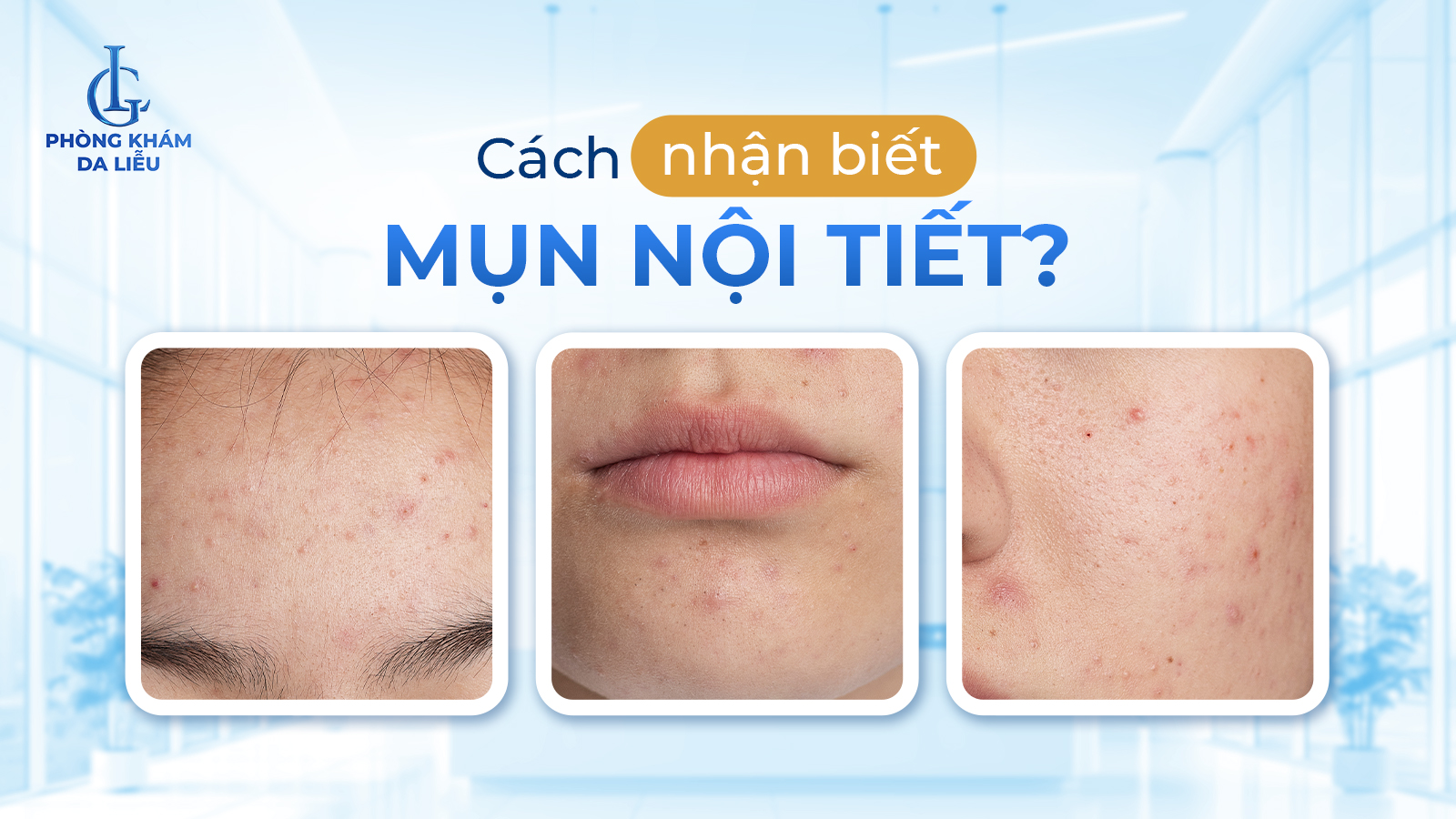 Làm sao biết mình bị mụn nội tiết