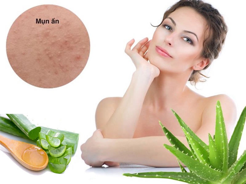 trị mụn ẩn tại nhà