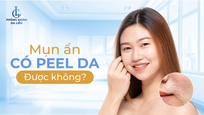 Mụn ẩn có peel da được không?